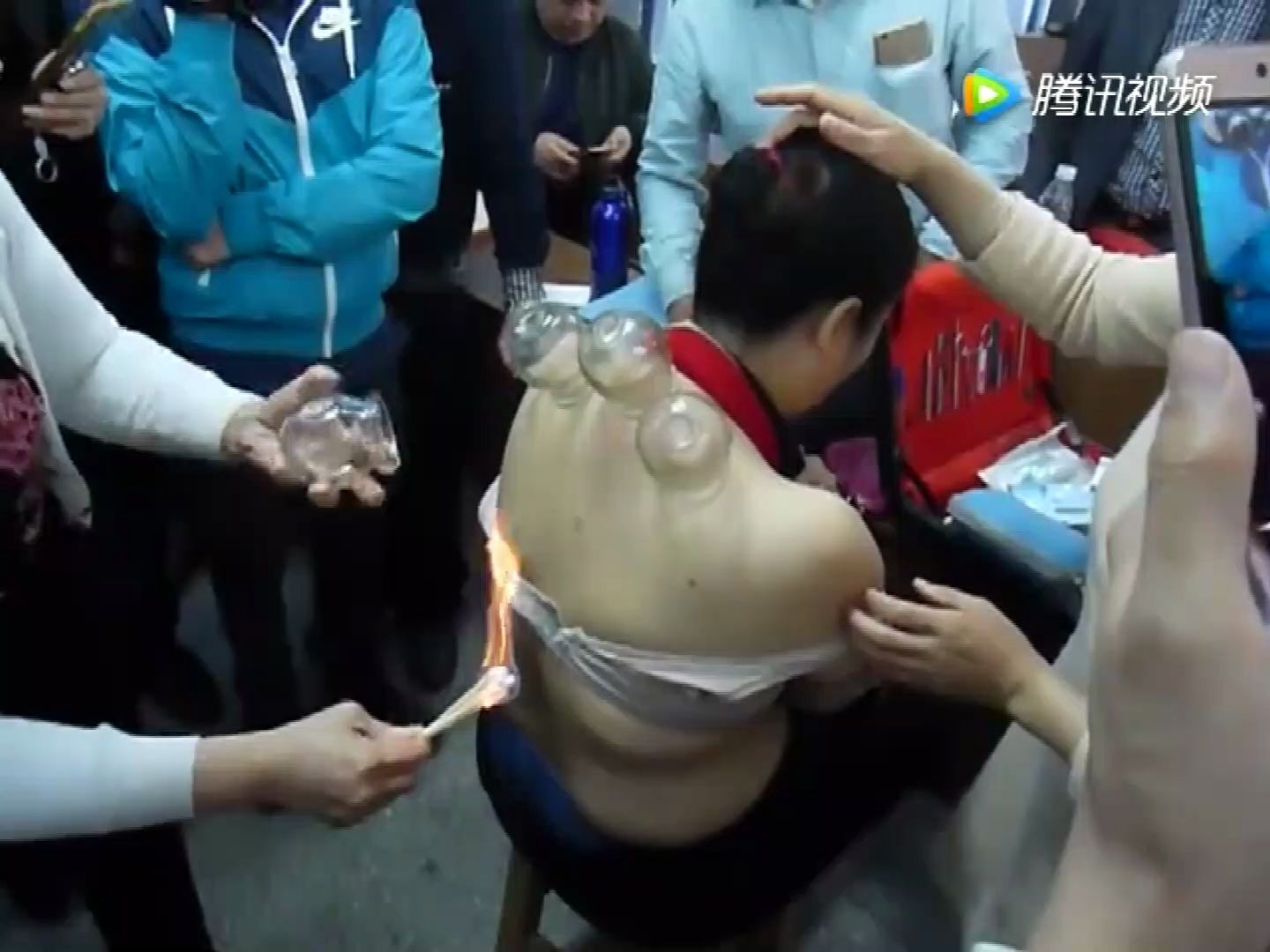 上海哪里可以刺血拔罐(上海哪家医院可以拔火罐)